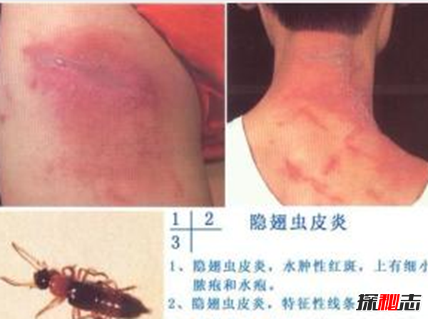 硫酸蟻是什么?怎樣預(yù)防硫酸蟻(發(fā)育完全變態(tài)夏秋最為常見)