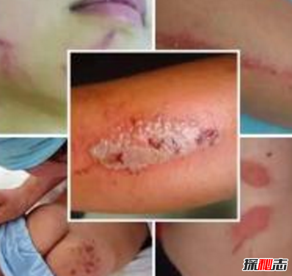 硫酸蟻是什么?怎樣預(yù)防硫酸蟻(發(fā)育完全變態(tài)夏秋最為常見)