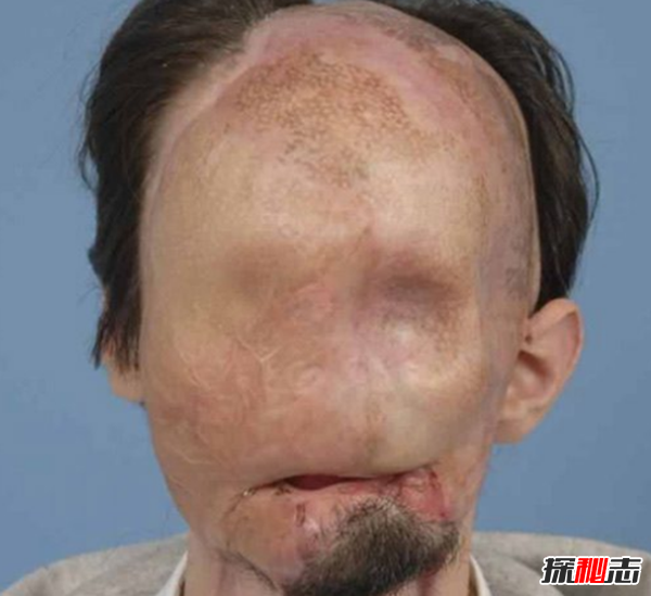世界上十大最古怪的男人,20歲小伙沒有臉可以活兩年