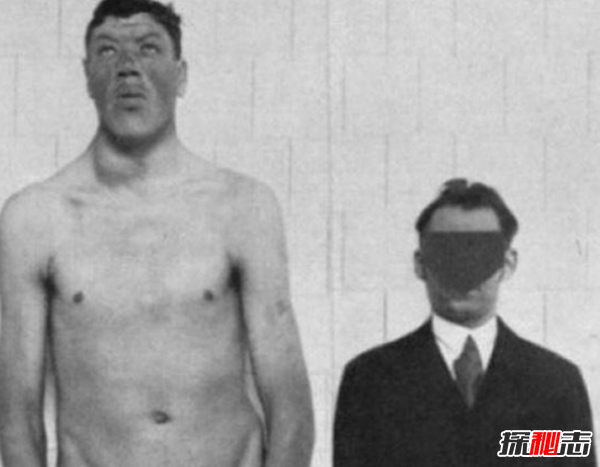 世界上十大最古怪的男人,20歲小伙沒有臉可以活兩年
